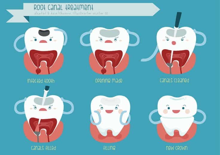 Root Canal Therapy Newcastle