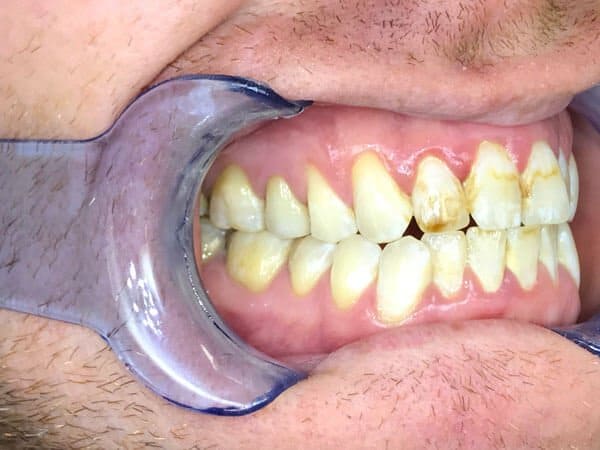 Dental Tooth Crown - After