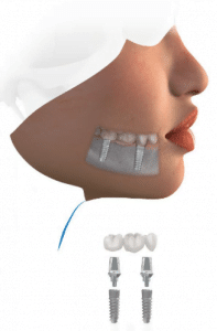 Dental Implants Newcastle - Replacing Teeth With A Fixed Bridge