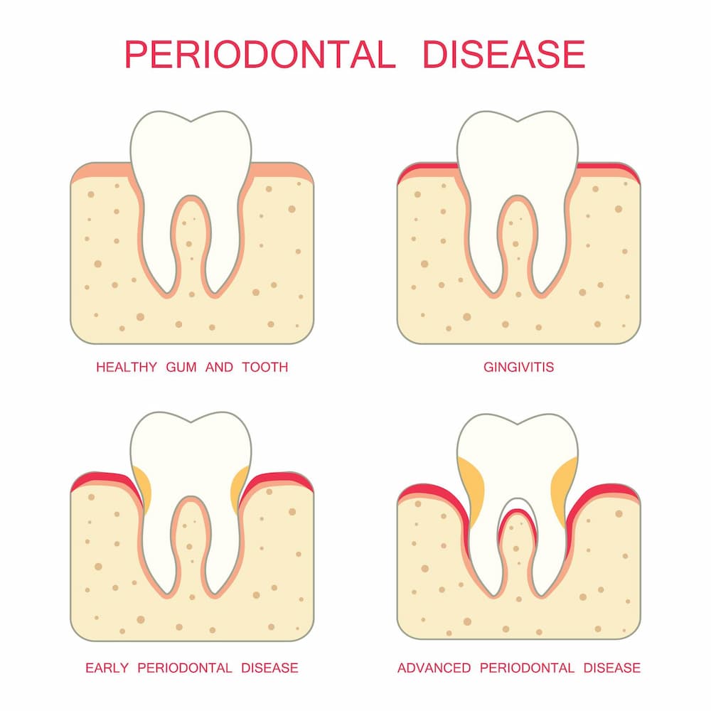 tooth periodontal disease