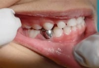 Stainless Steel Crowns for Baby Teeth