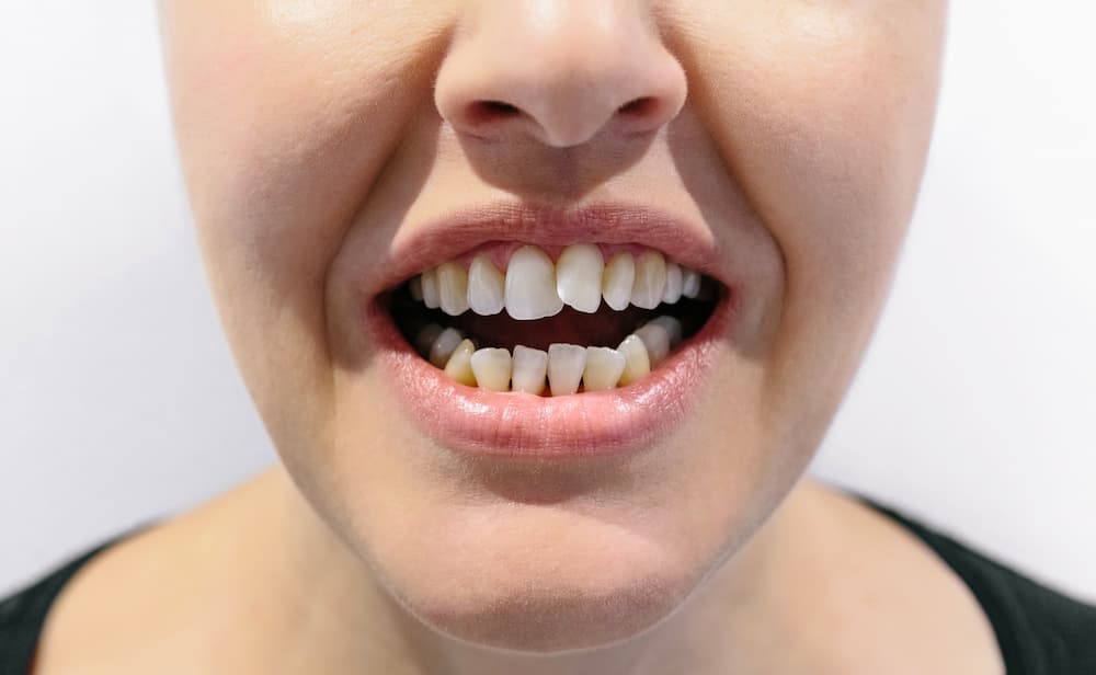 woman with crooked teeth