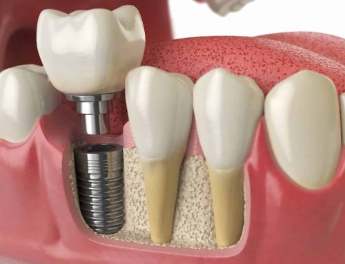 What Are Dental Implants?