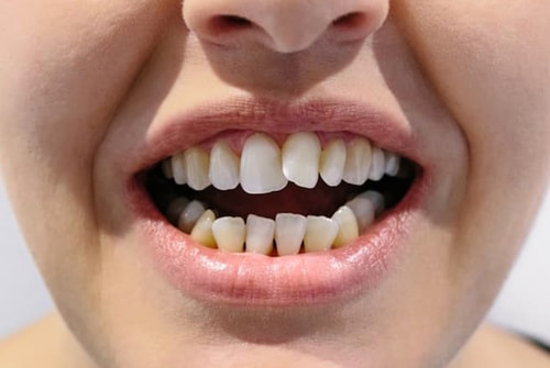 teeth crooked misaligned misshapen