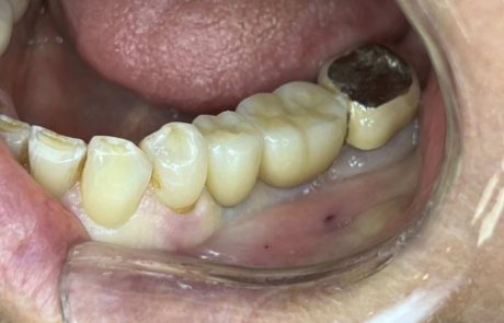 dental-implants-back-after
