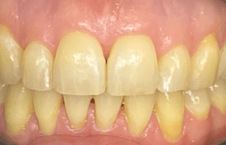 teeth whitening - before